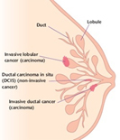 Infiltrating Lobular Carcinoma (ILC)