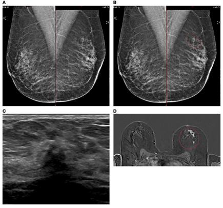 Infiltrating Lobular Carcinoma (ILC)