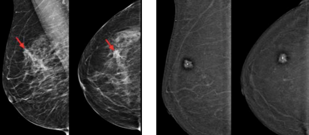 Infiltrating Lobular Carcinoma (ILC)