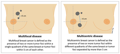 Infiltrating Lobular Carcinoma (ILC)