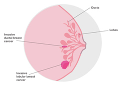 Infiltrating Lobular Carcinoma (ILC)