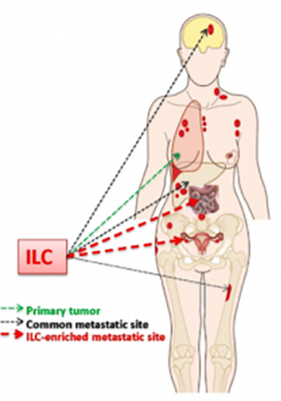 Infiltrating Lobular Carcinoma (ILC)