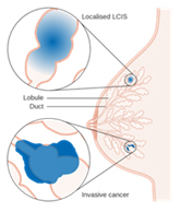 Infiltrating Lobular Carcinoma (ILC)