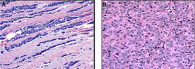 Infiltrating Lobular Carcinoma (ILC)