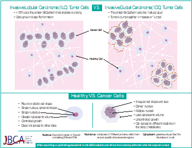 Infiltrating Lobular Carcinoma (ILC)