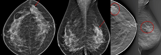 Infiltrating Lobular Carcinoma (ILC)