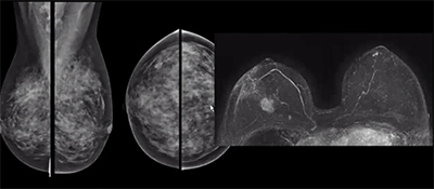 Infiltrating Lobular Carcinoma (ILC)