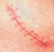 Incisions/Scars for Benign Breast Lump Removal