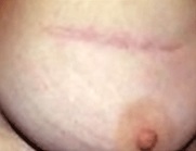 Incisions/Scars for Benign Breast Lump Removal 