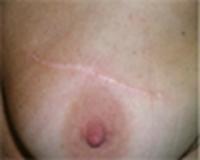 Incisions/Scars for Benign Breast Lump Removal 