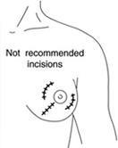 Incisions/Scars for Benign Breast Lump Removal 