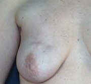 Incisions/Scars for Benign Breast Lump Removal 