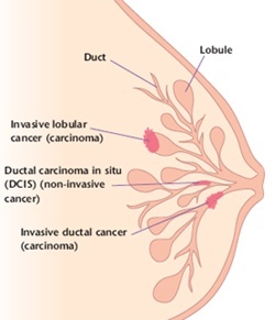 Infiltrating Lobular Carcinoma (ILC)