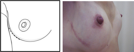 Nipple - Sparing Mastectomy (NSM) 