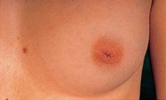 Inverted Nipples