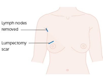  Lumpectomy vs. Mastectomy: How to Choose 