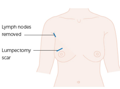 Breast Cancer Surgery Types