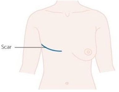  Lumpectomy vs. Mastectomy: How to Choose 