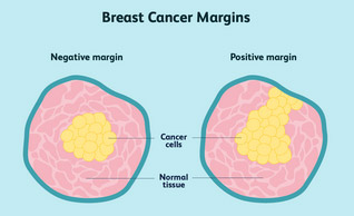 Lumpectomy vs Mastectomy: How to Choose