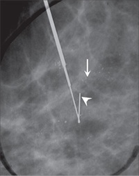 Mammogram1