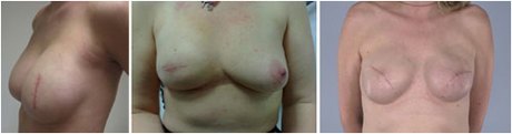 Skin-Sparing Mastectomy (SSM)