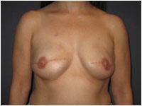 Skin-Sparing Mastectomy (SSM)