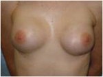 Nipple-Sparing Mastectomy (NSM)