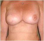 Nipple-Sparing Mastectomy (NSM)