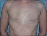 Nipple-Sparing Mastectomy (NSM)