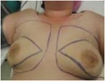 Nipple-Sparing Mastectomy (NSM)