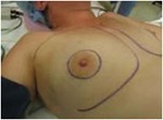 Nipple-Sparing Mastectomy (NSM)