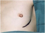 Nipple-Sparing Mastectomy (NSM)