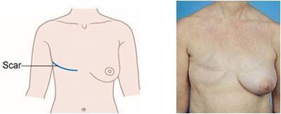 Simple or Total Mastectomy