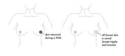 Skin-Sparing Mastectomy (SSM)