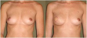 Skin-Sparing Mastectomy (SSM)