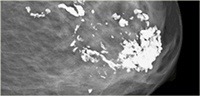 Breast Calcifications