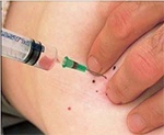 Needle Aspiration