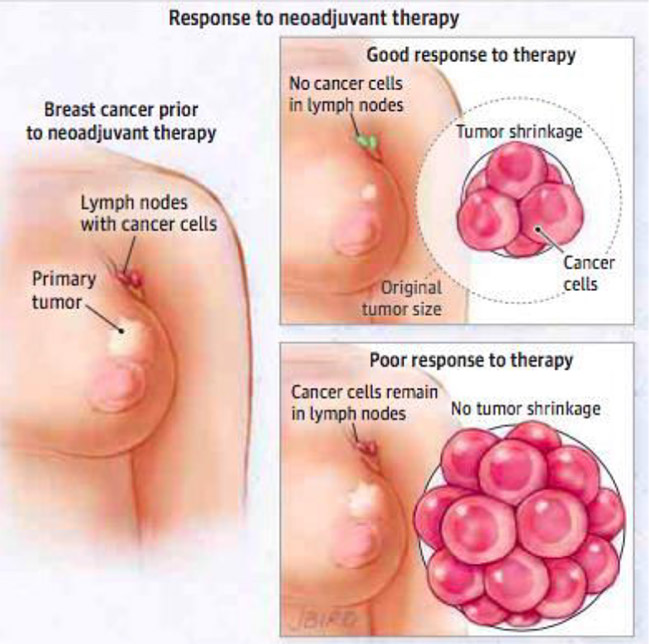 NEOADJUVANT THERAPY OVERVIEW