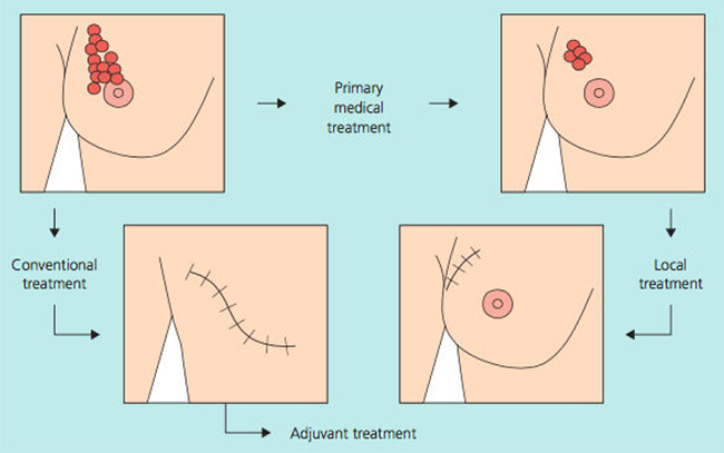 NEOADJUVANT THERAPY OVERVIEW