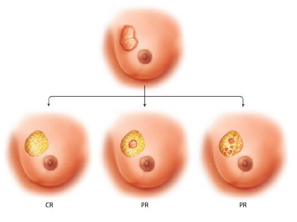 NEOADJUVANT THERAPY OVERVIEW