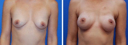 Nipple - Sparing Mastectomy (NSM) 