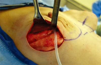 Nipple-sparing mastectomy