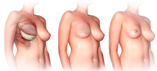 Nipple Sparing Mastectomy