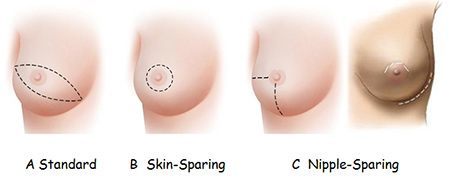 Nipple-Sparing Mastectomy as Safe as More Radical Surgical Options