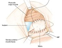 Nipple-sparing mastectomy with DTI