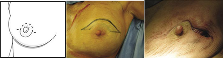 Nipple - Sparing Mastectomy (NSM) 