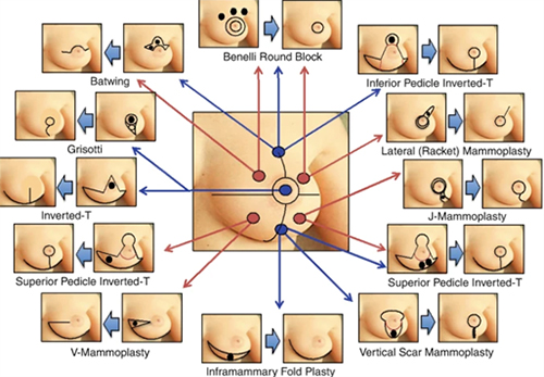 Oncoplastic Breast Surgery Melbourne, VIC