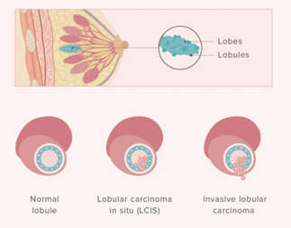 Surgical Clips in Breast-conserving Surgery: Do they Represent the Tumour  Bed Accurately?