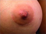 Lower Breast