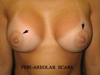 Incisions/Scars for Benign Breast Lump Removal 